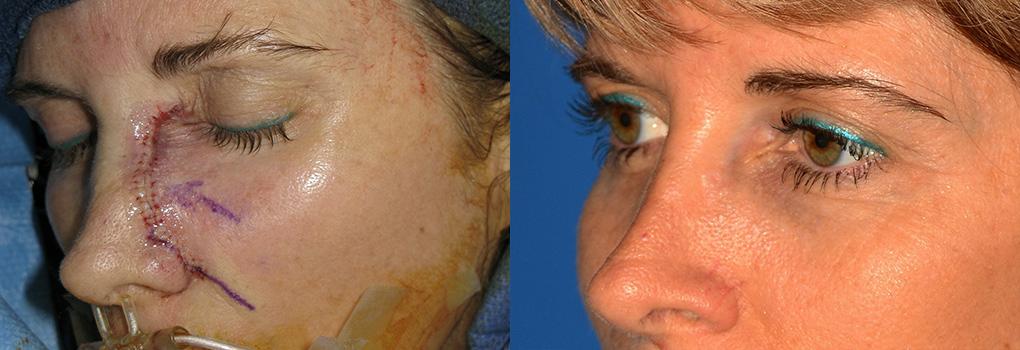 Mohs Surgery and Skin Cancer Photos Melbourne, FL